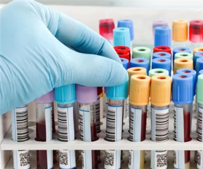 Vákuumos vérvételi cső, piros kupak EDTA vérmintavételi cső Vacutainer vérvét...